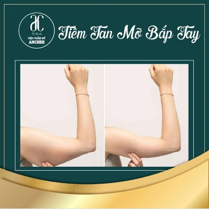 tiêm tan mỡ bắp tay