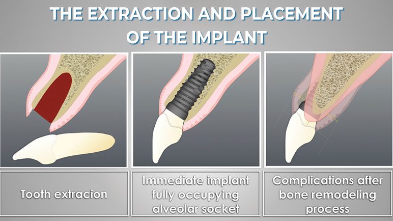Cross-section diagram showing the three components of a dental implant: post, abutment, and crown.